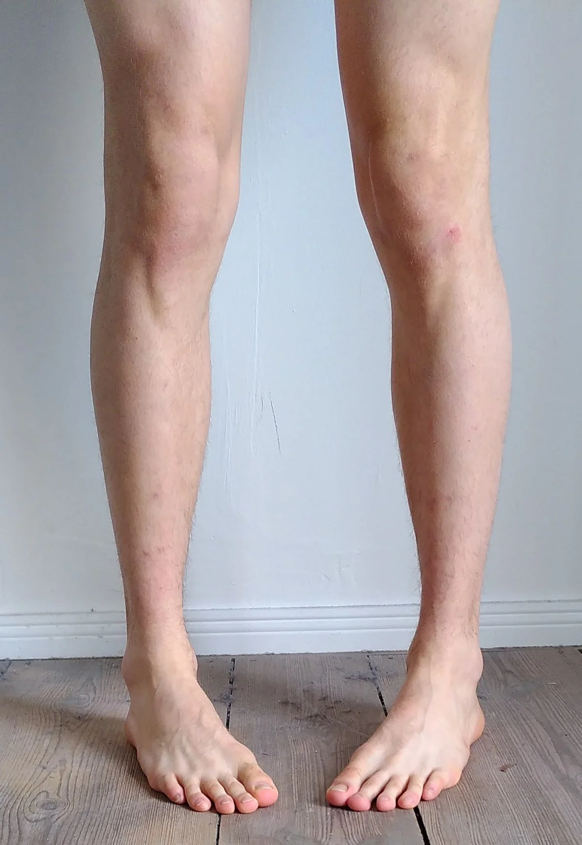 1200px-In-toeing.webp