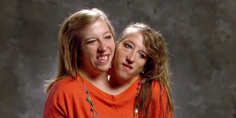 Abby and Brittany Hensell