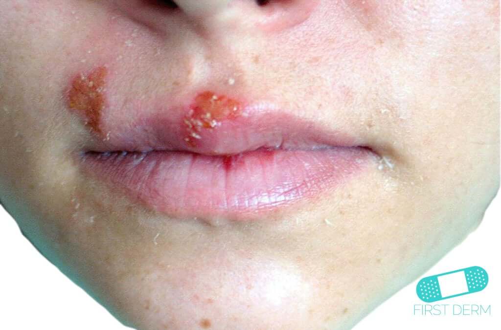 Oral-Herpes-Cold-sores-01-mouth-ICD-10-B00.5.jpg