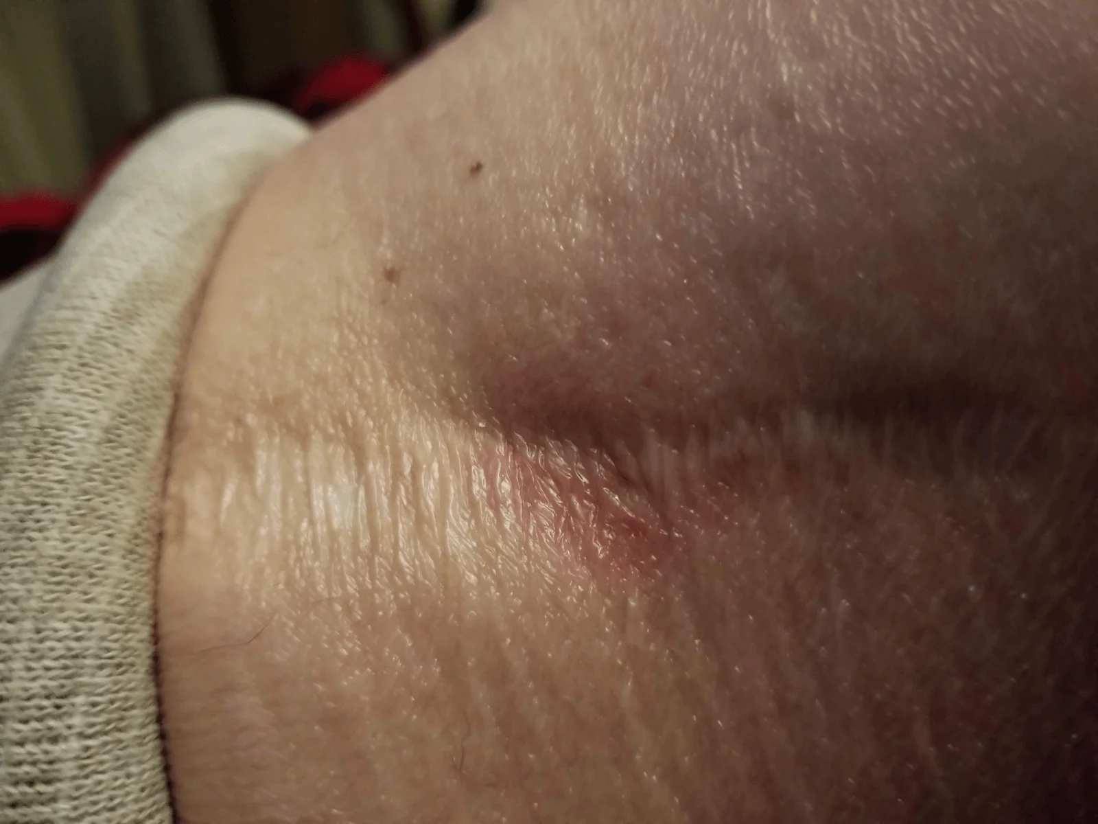 Sore on leg.webp