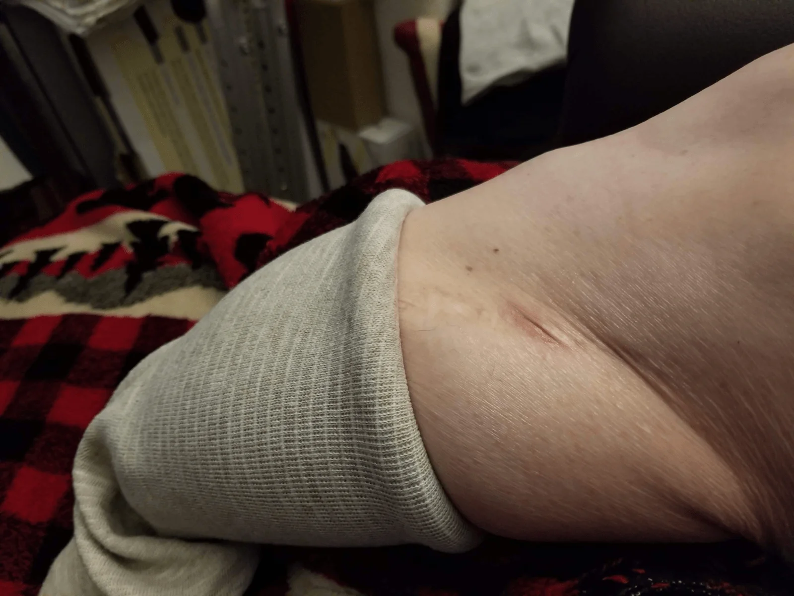 Sore on leg2.webp